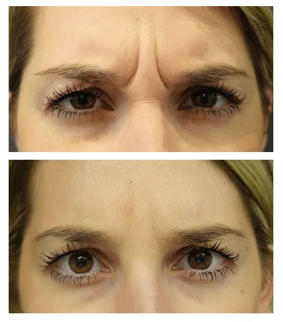 BA-Botox-glabella-NR