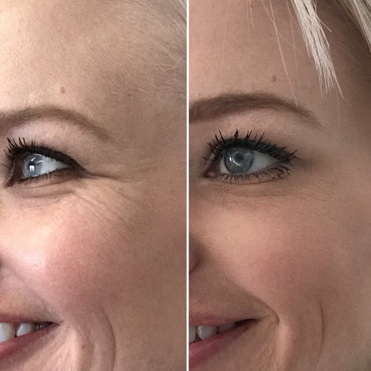 Botox crows feet square