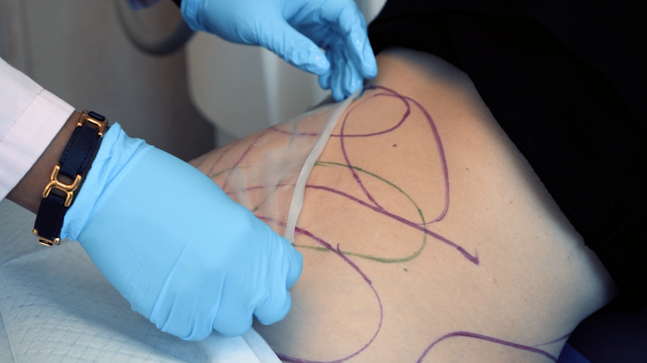 Cool Sculpting event landing iamge