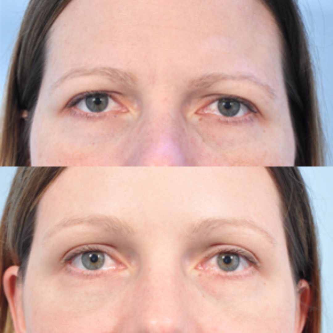 botox bas (1)