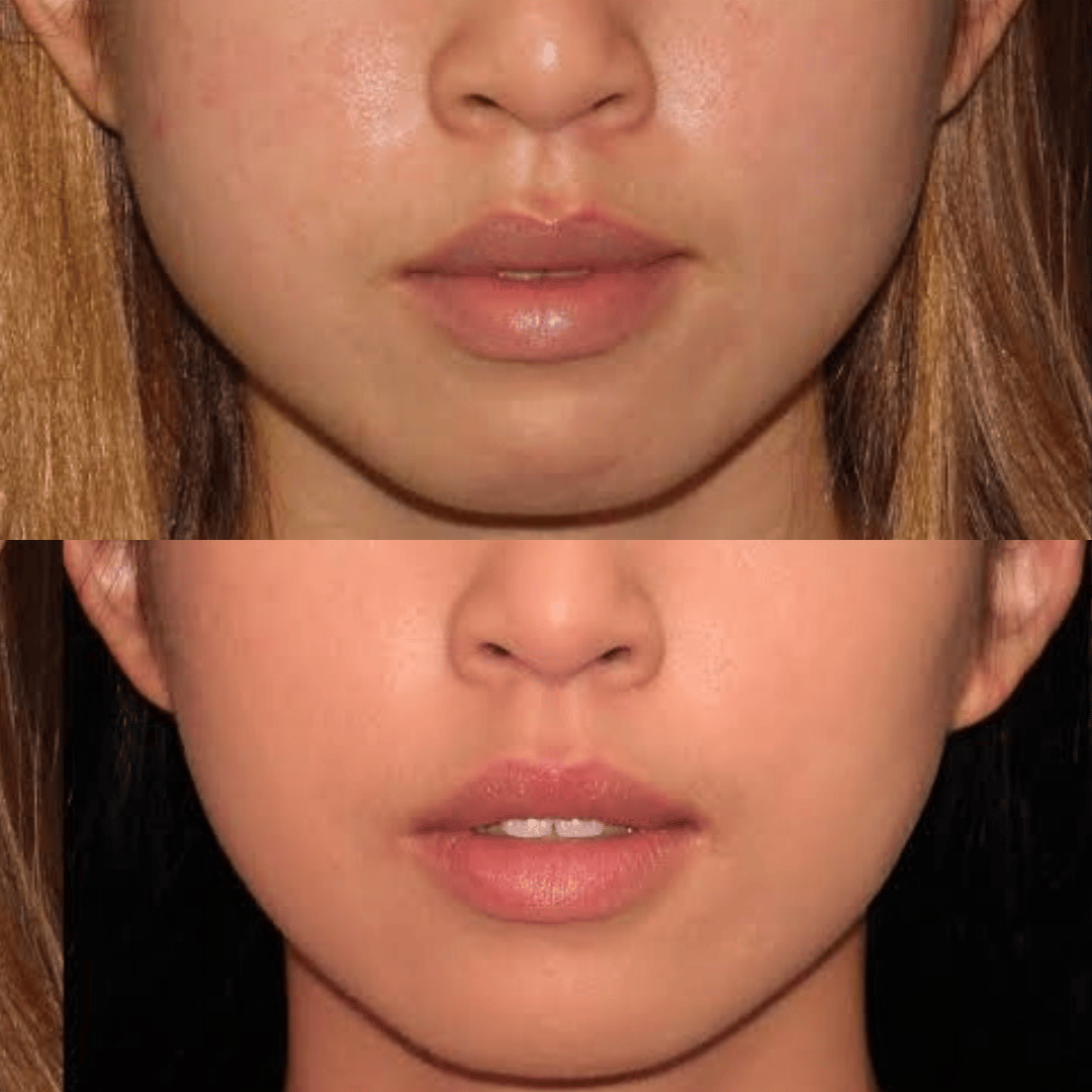 botox bas