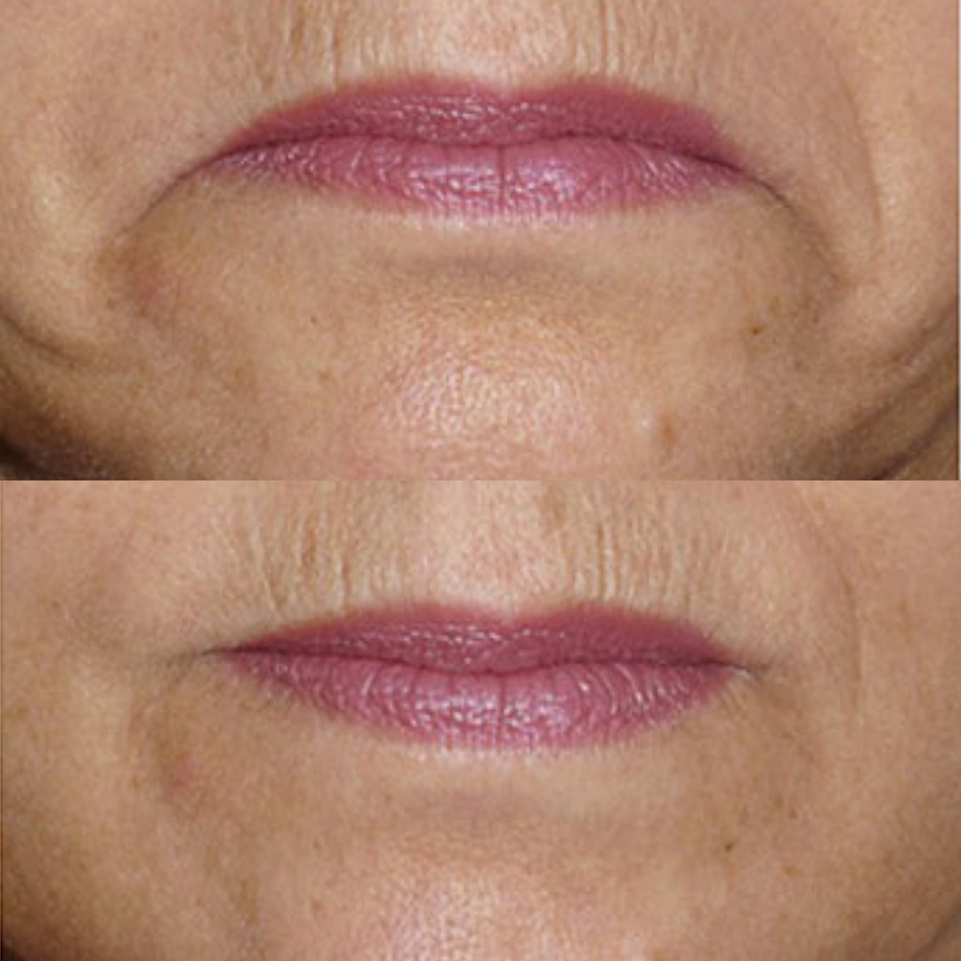 downward mouth botox ba