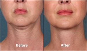 FDA Approves Kybella for Treatment of Submental Fullness